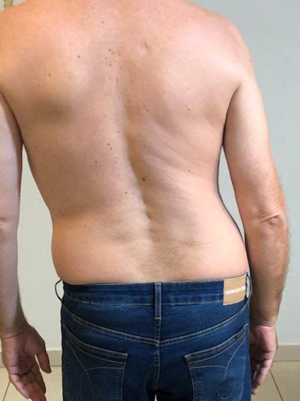 Avaliação postural do paciente antes do tratamento