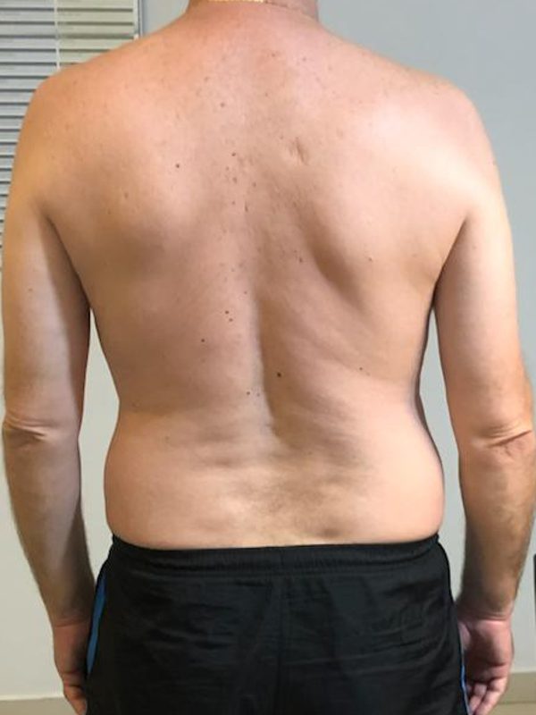 Avaliação postural do paciente após o tratamento conservador
